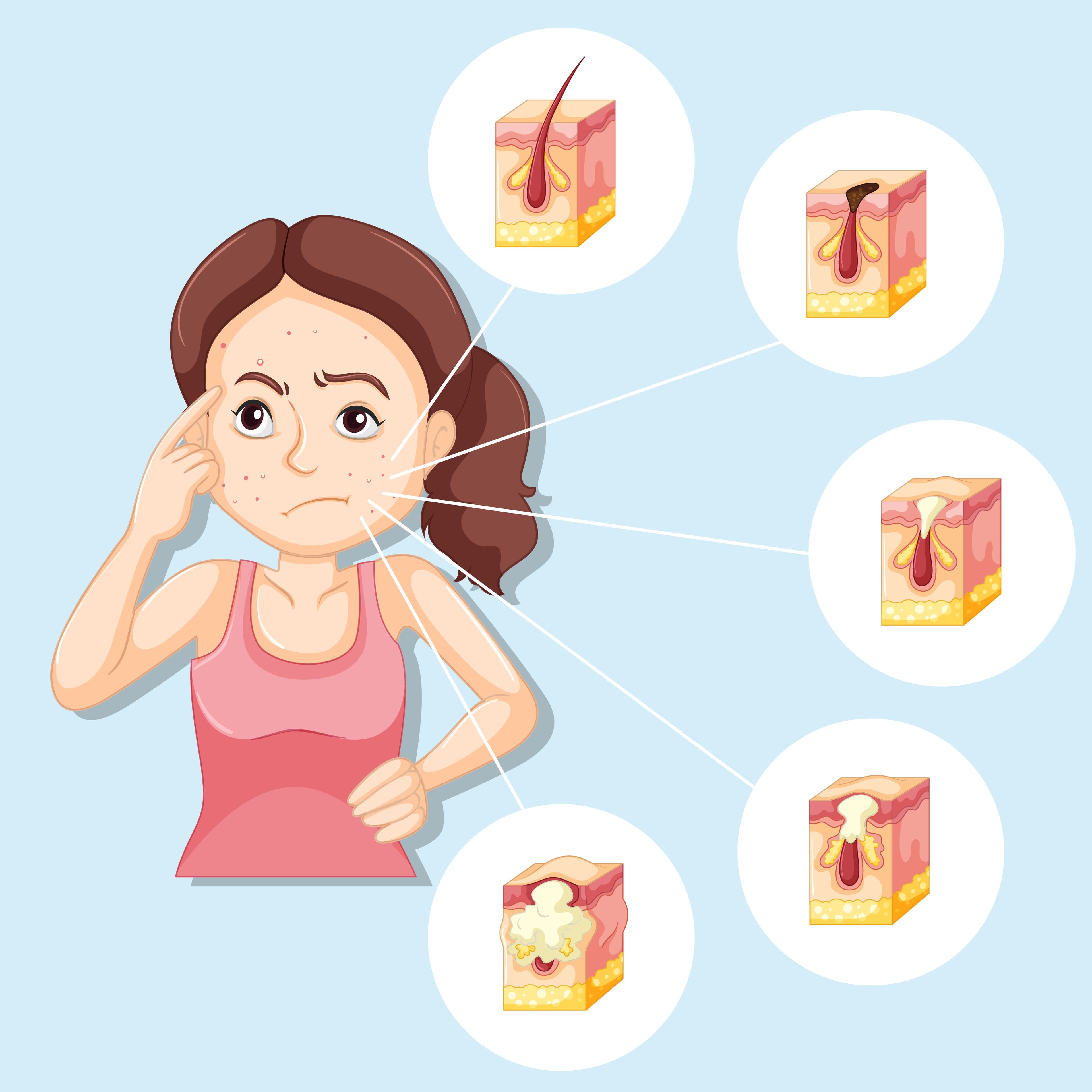 Struggles Of Having PCOS - The Real Deal!